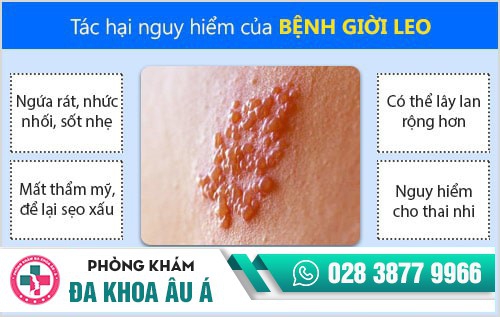 Tất tần tật những kiến thức về bệnh giời leo