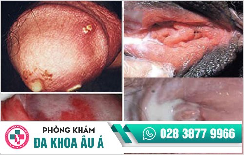 bệnh lây qua đường quan hệ tình dục