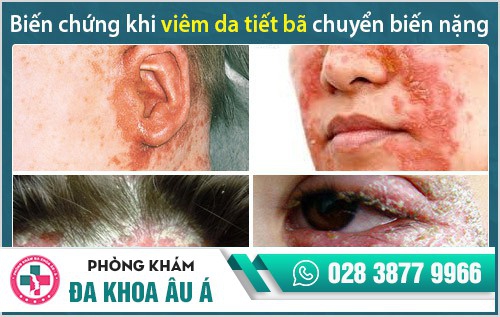 Viêm da tiết bã