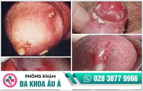 Biểu hiện bệnh lậu - đa số đều không biết đến thông tin này