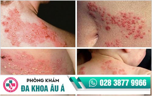 Tất tần tật những kiến thức về bệnh giời leo