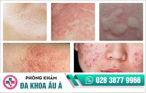 dị ứng da