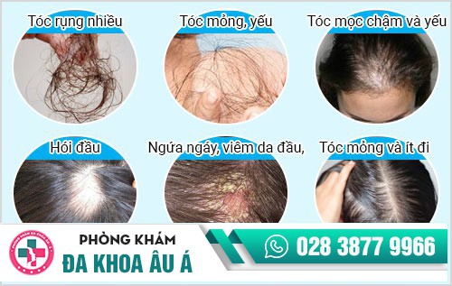 phòng khám điều trị rụng tóc