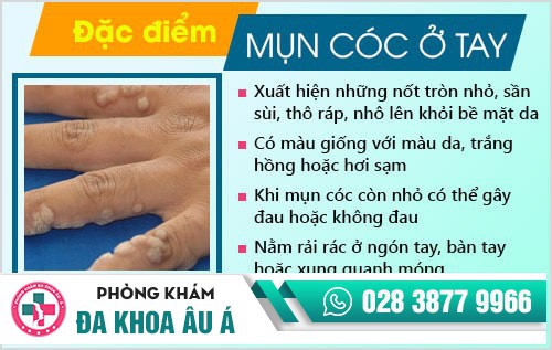 mụn cóc ở tay