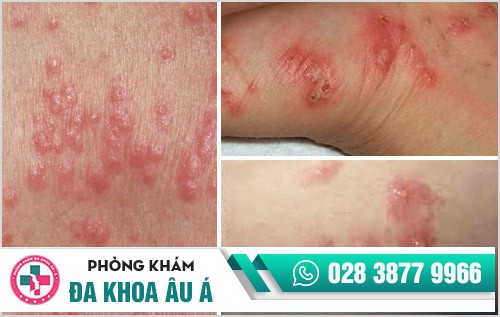 cách trị bệnh ghẻ