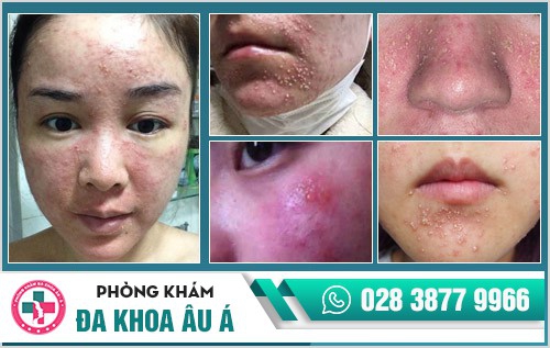 Dị ứng da mặt