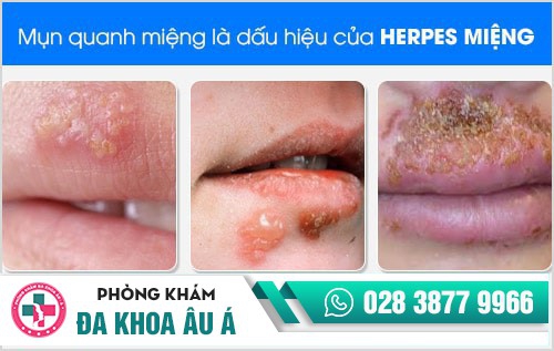 Nổi mụn quanh miệng