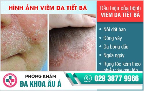 Viêm da tiết bã