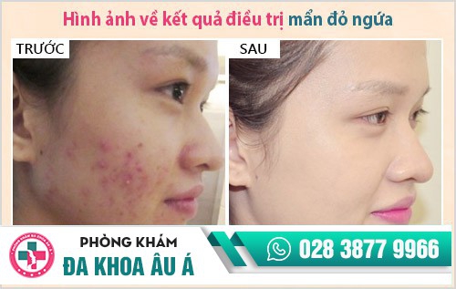 mẩn đỏ ngứa