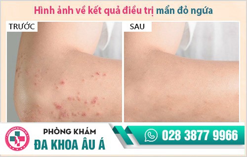 mẩn đỏ ngứa