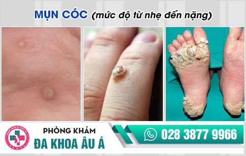 mụn cóc