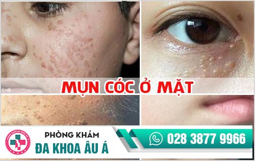 Mụn cóc ở mặt: Dấu hiệu và cách điều trị