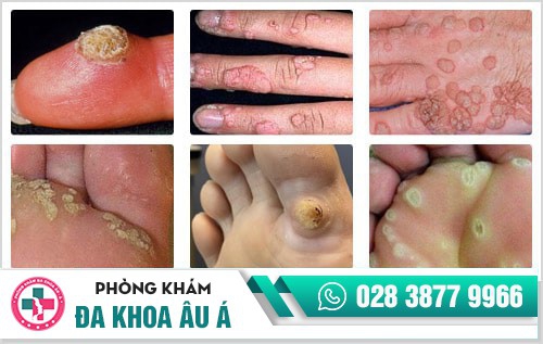 mụn cóc