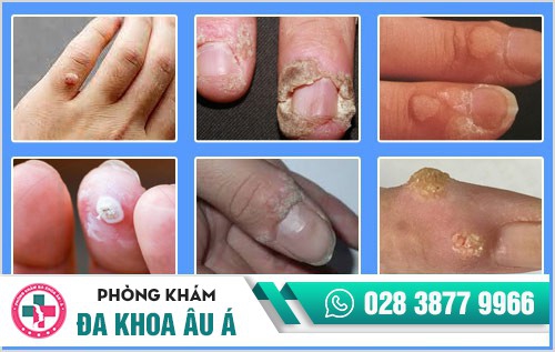 mụn cóc ở tay
