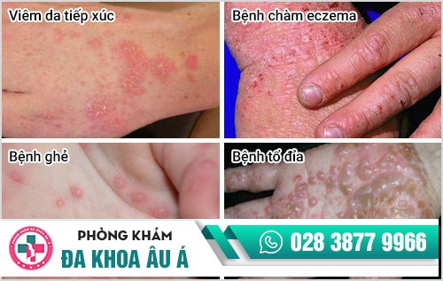 mụn nước ở tay