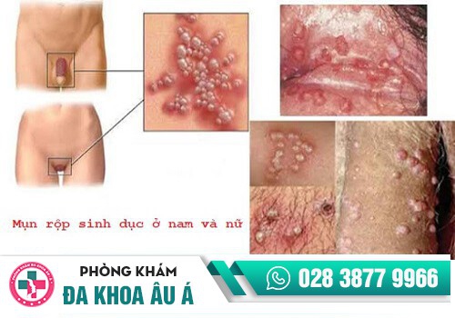  Điều trị mụn rộp sinh dục bằng Laser, đốt điện, đốt lạnh