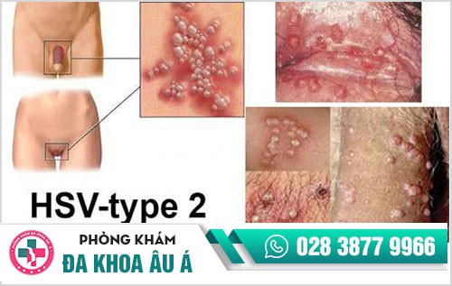Mụn rộp sinh dục