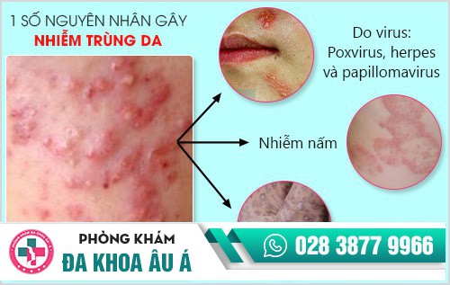 nhiễm trùng da
