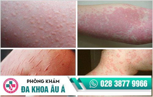 Nổi mề đay