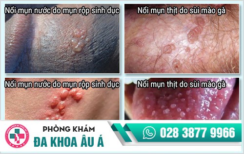 nổi mụn nước 