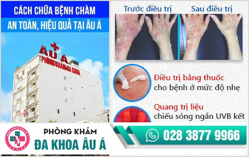 chữa bệnh chàm