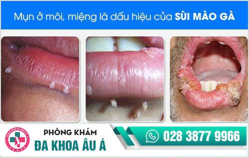 Nổi mụn quanh miệng