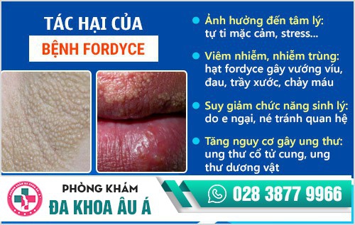 Hạt fordyce có nguy hiểm không?