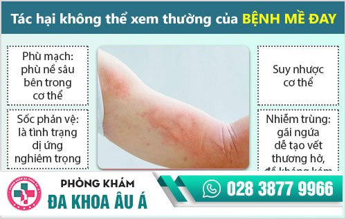 Nổi mề đay