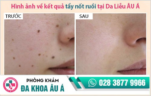 địa chỉ phá nốt ruồi