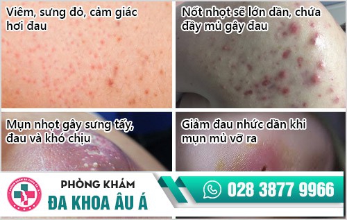 mụn nhọt