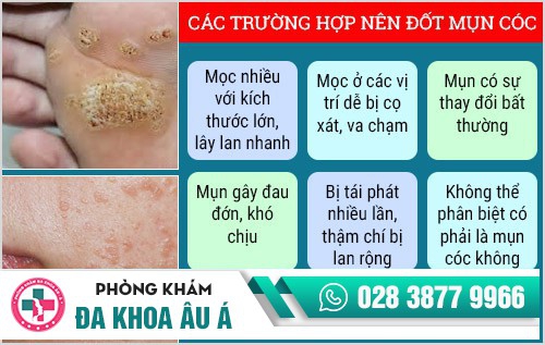 đốt mụn cóc ở đâu