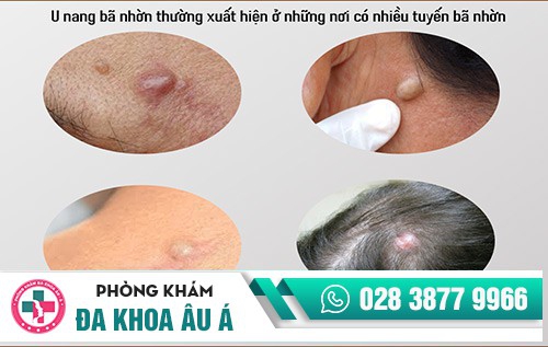 Tổng quan về u nang bã nhờn, nguyên nhân và cách điều trị