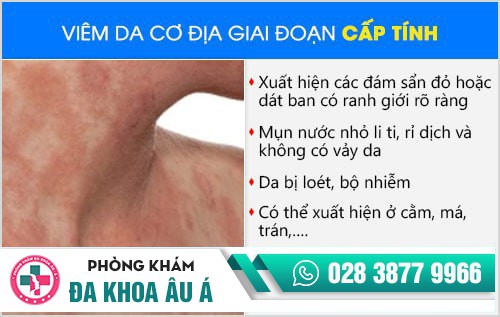 viêm da cơ địa
