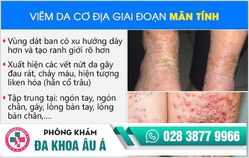 viêm da cơ địa