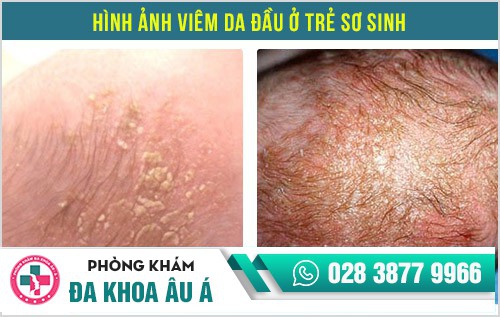 viêm da đầu