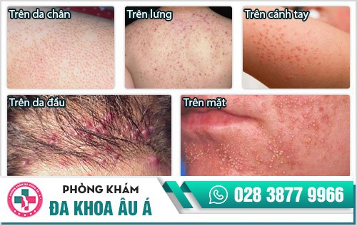 viêm nang lông